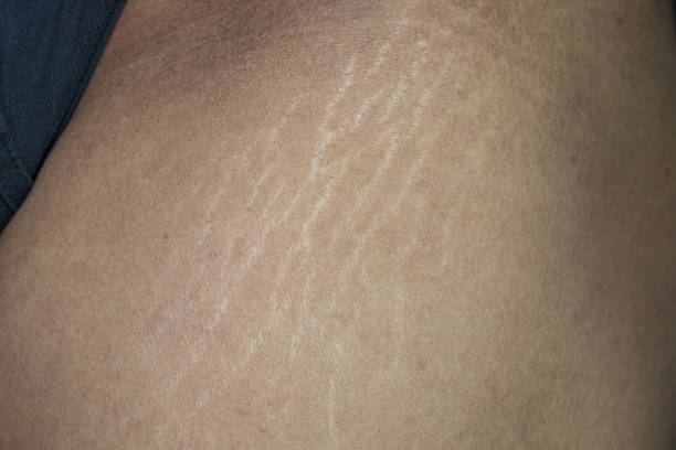How To Get Rid of Stretch Marks with Natural Home Remedies